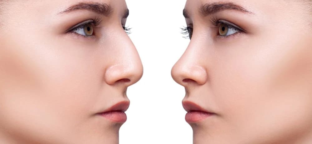 Rhinoplasty (Nose Aesthetic)